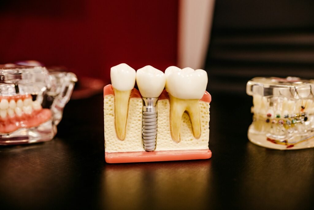 Modello di impianto dentale con corona